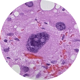 Cytomegalia